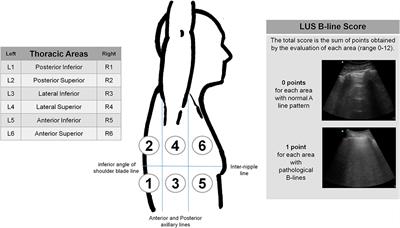 Frontiers | Lung Ultrasound As A First-Line Test In The Evaluation Of ...